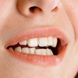 Persistent Teeth Clenching (bruxism)