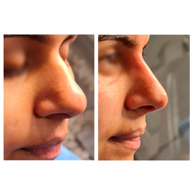 before & after 1 (Liquid Rhinoplasty)