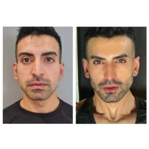 before & after 1 (face sculpting)