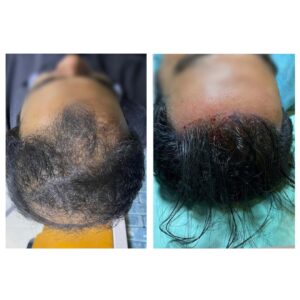 before & after (Hair Transplant)