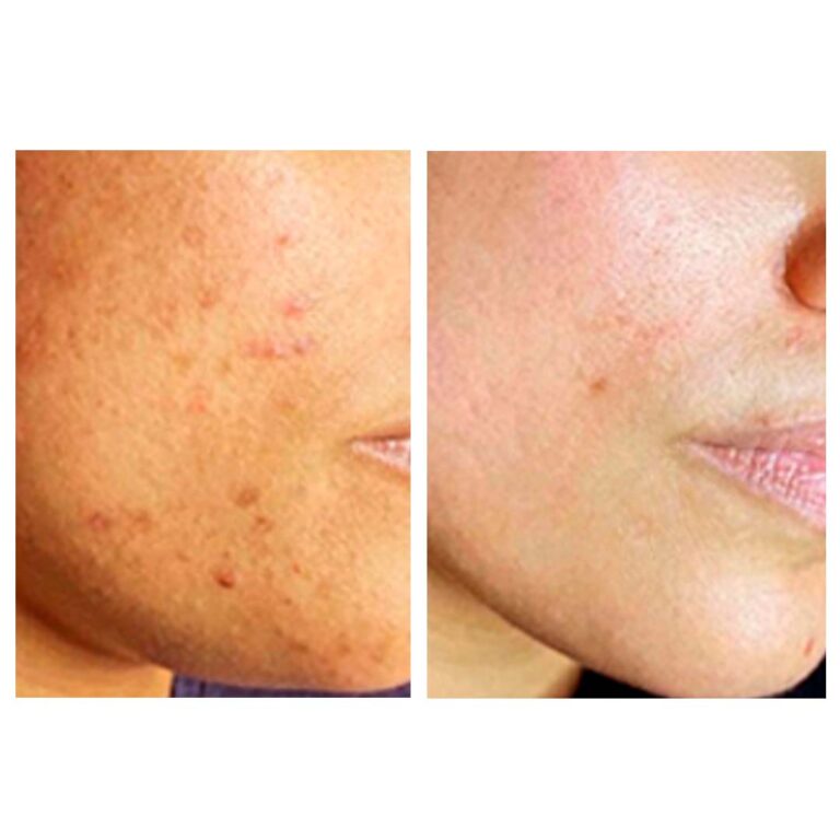 before & after (acne & scar)