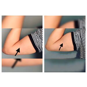 before & after (body sculpting )