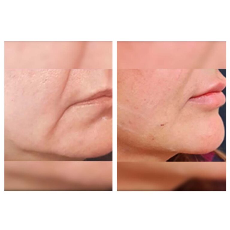 before & after (thread lift)