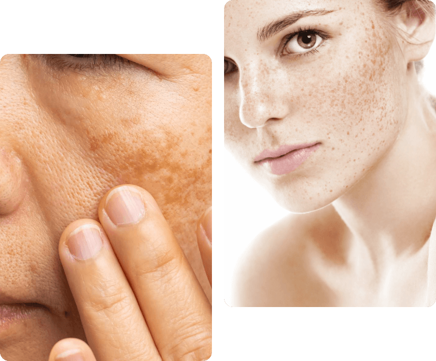 Melasma treatment in Islamabad for deep facial pigmentation
