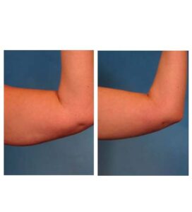 before & after post (Clatuu)