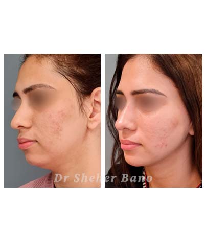 before & after post (Face Sculpting)