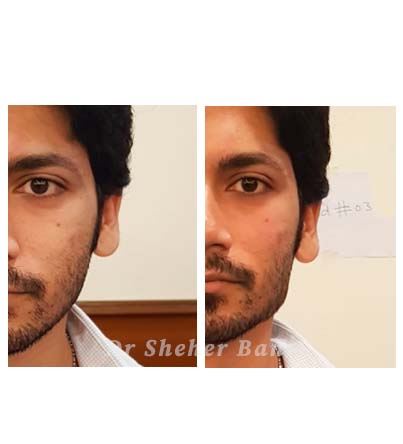 before & after post (Gentle Face Augmentation for Men )