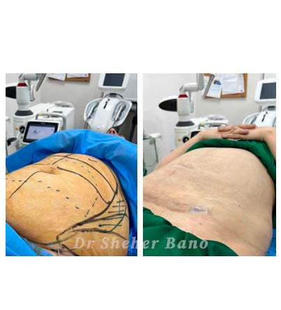 before & after post (Laser Lipolysis treatment)