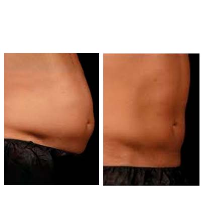 before & after post (Laser Lipolysis)