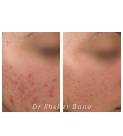 before & after post (acne treatment)