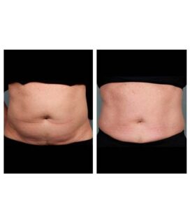 before & after post (emsculpt)