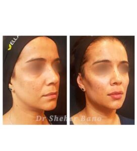 before & after post (face sculpting treatment)