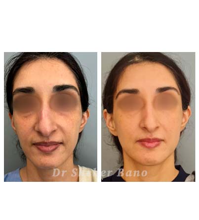 before & after post (hybird non-surgical face lift)