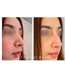 before & after post (liquid rhinoplasty)