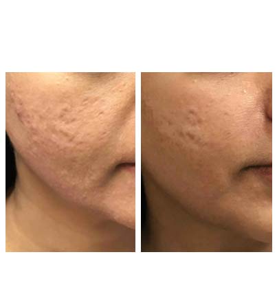 before & after post (micro-needling)