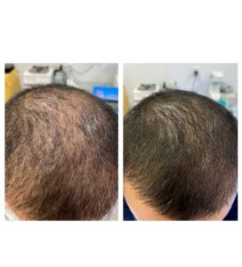 before & after post (regenera)
