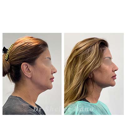 before & after post (thread lift for neck)