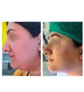 before & after post (treatment of double chin)