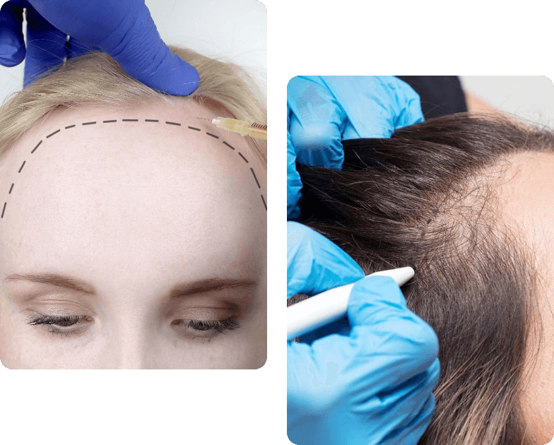 Hair Loss Treatment in Islamabad showing professional hair restoration procedure for receding hairline under expert medical care