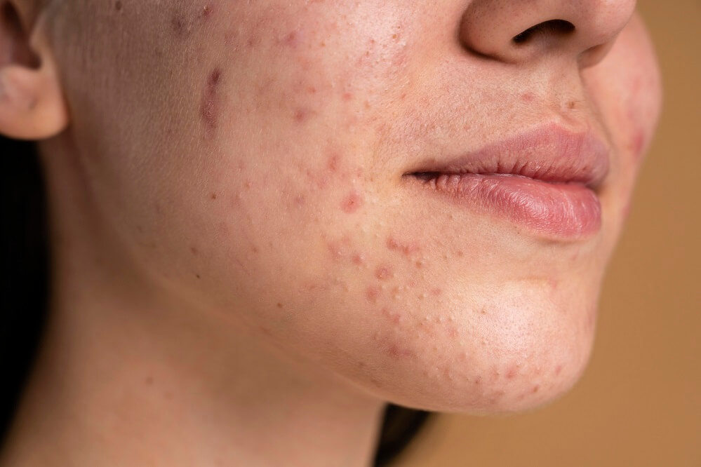 acne scars treatment