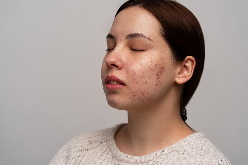 Causes of Acne and how to get rid of acne