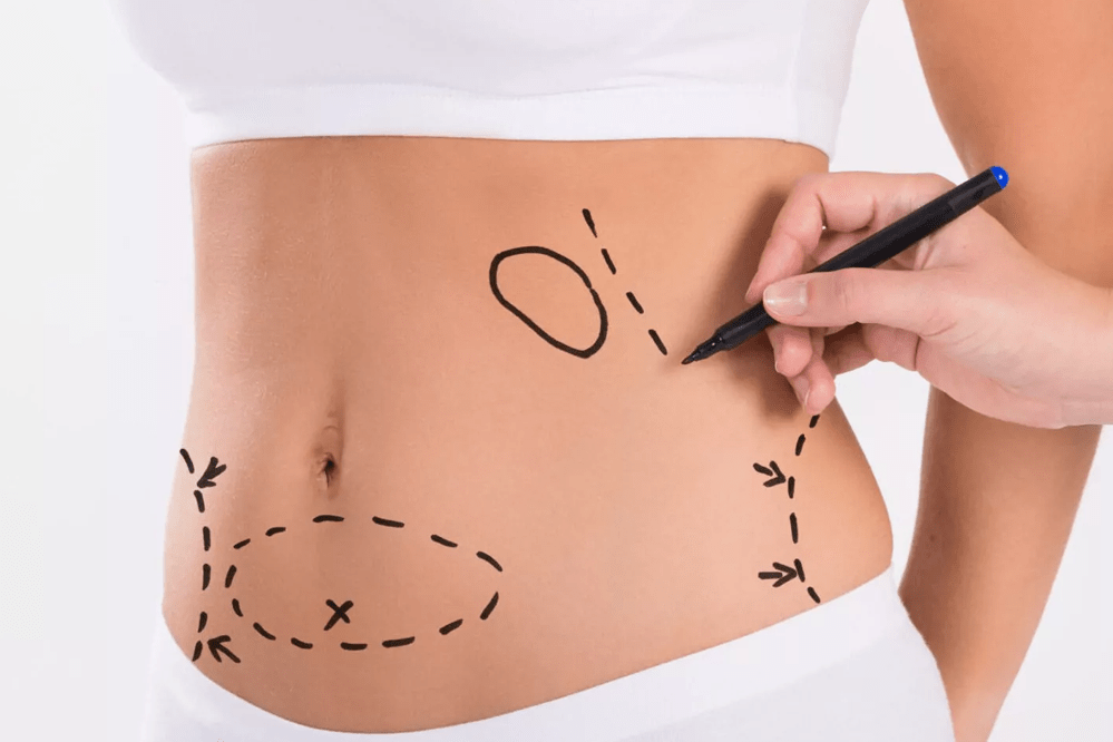 liposuction