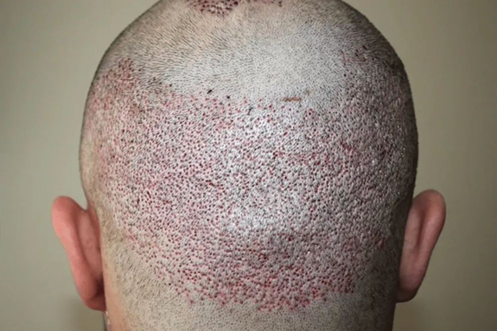 Hair Transplant Procedure- FUE