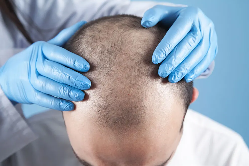 Hair Transplant Procedure- FUT