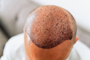 hair transplant cost