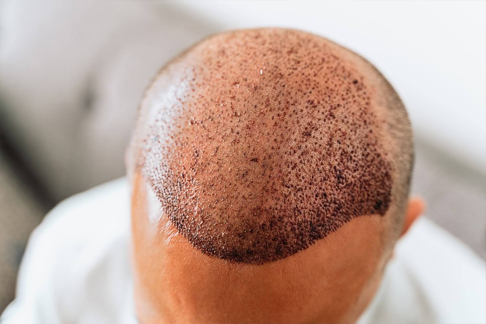 hair transplant cost