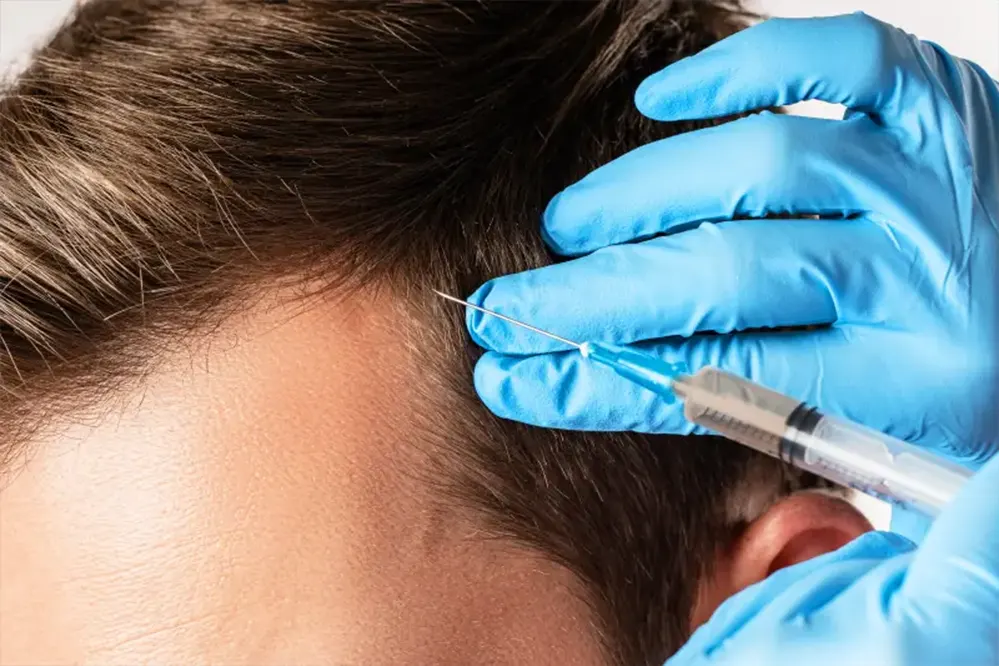 Hair Transplant Procedure- PRP therapy