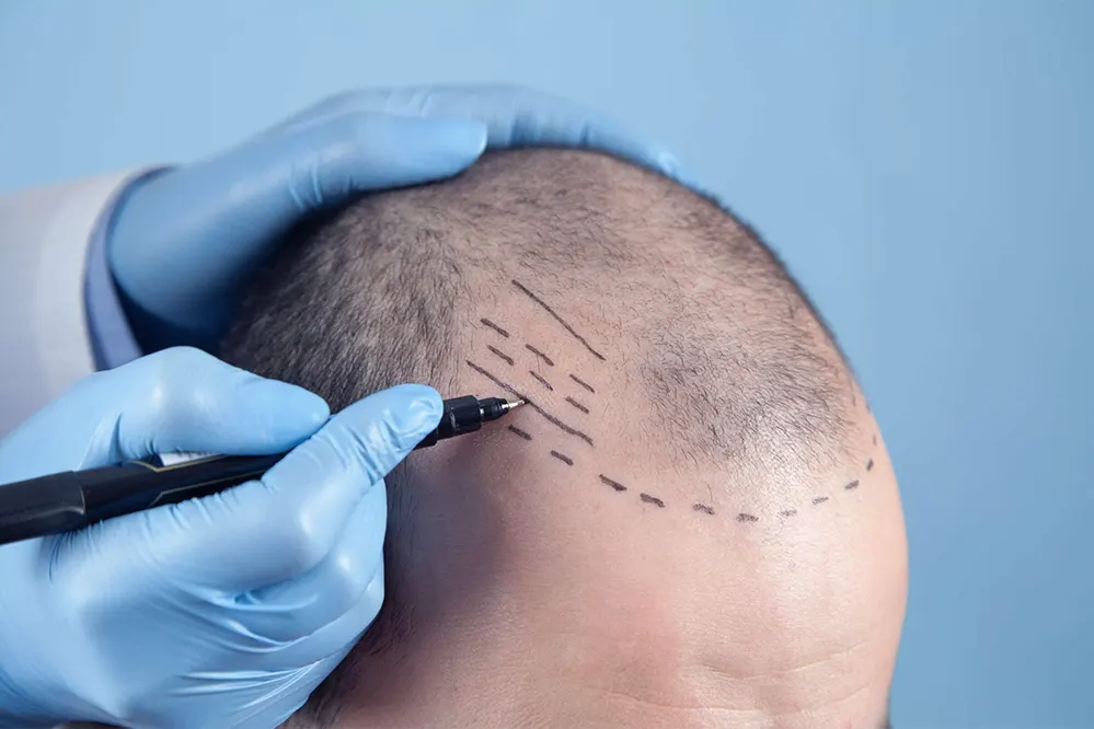 Hair Transplant Procedure