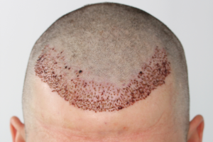 hair transplant success stories