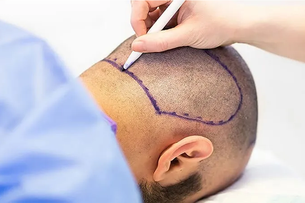 hair transplant success stories