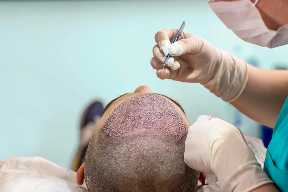 hair transplant success stories